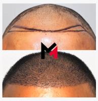 MAXIM Hair Restoration image 1